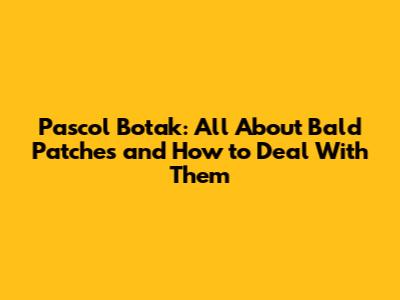 Pascol Botak: All About Bald Patches and How to Deal With Them